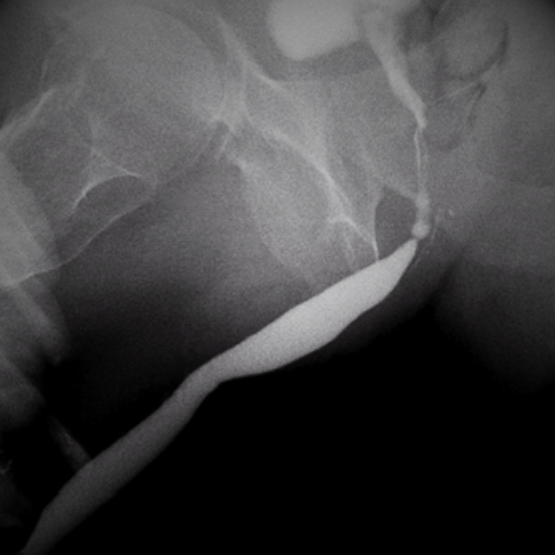 Dilatación Uretral con Balón de Paclitaxel: Un Análisis Esencial