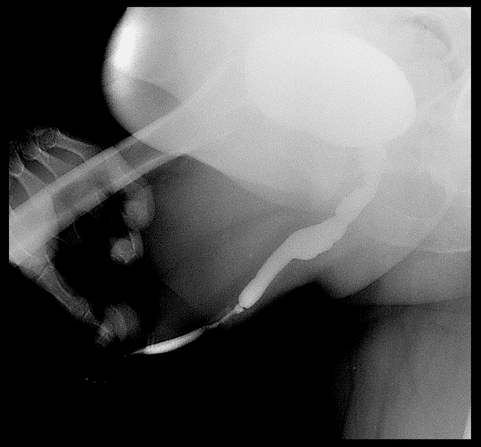 Cistouretrografía en fase miccional que revela estenosis uretral