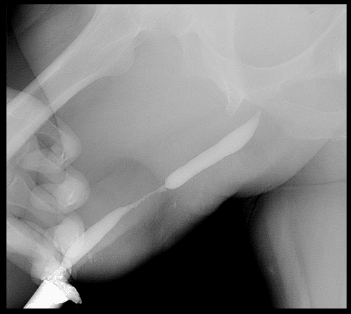 Cistouretrografía en fase retrógrada que revela estenosis uretral