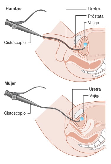 cistoscopia-diagrama