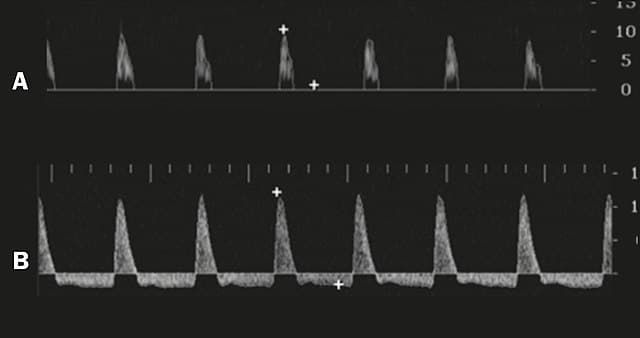 Ecografía doppler de pene