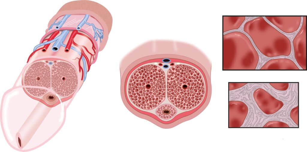 Cuerpos cavernosos del pene, estructura afectada por la enfermedad de Peyronie