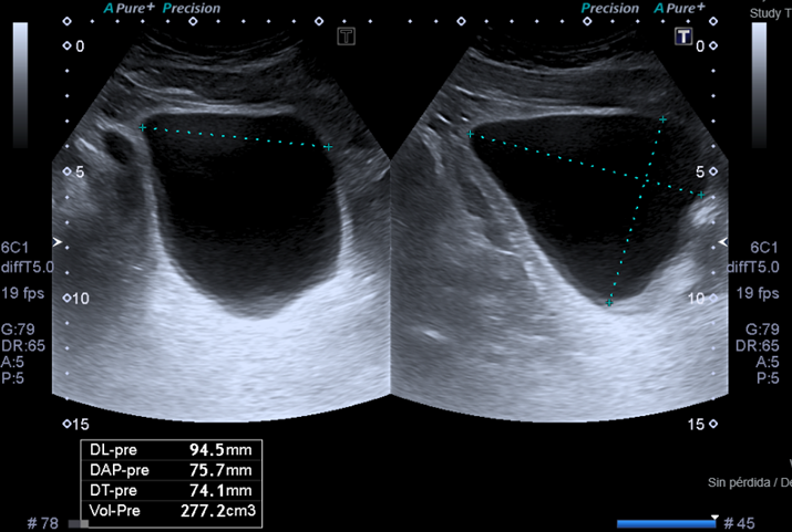 Captura de una ecografía urinaria en la cual se mide el residuo postmiccional