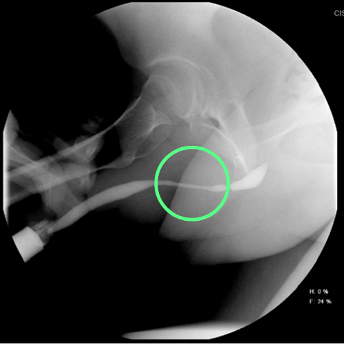 cistouretrografía que revela una estenosis en la porción bulbar de la uretra