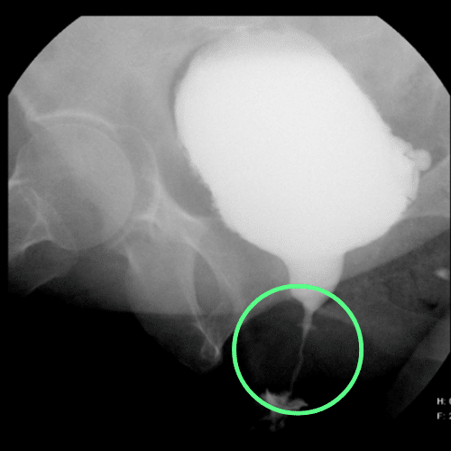 Cistouretrografía que revela estenosis de la uretra femenina