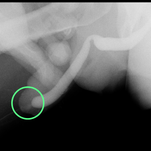 cistouretrografía que revela una estenosis de la fosa navicular de la uretra