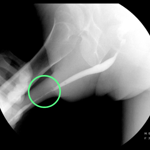 cistouretrografía que revela una estenosis de la porción péndula de la uretra