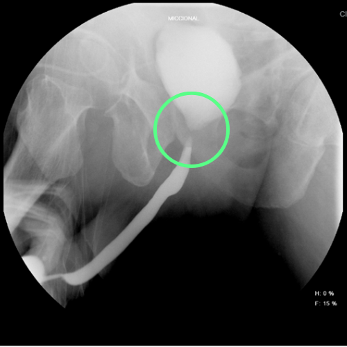 cistouretrografía que revela una estenosis en la porción posterior de la uretra