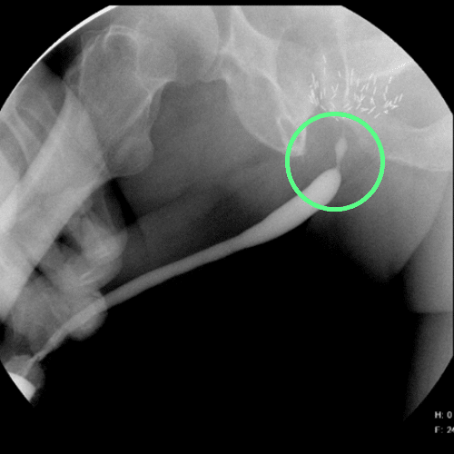 Imagen de cistouretrografía que revela una estenosis de la porción bulbar de la uretra de corta longitud