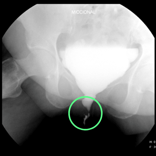 Cistouretrografía que muestra una estenosis del tercio distal de la uretra en una paciente mujer