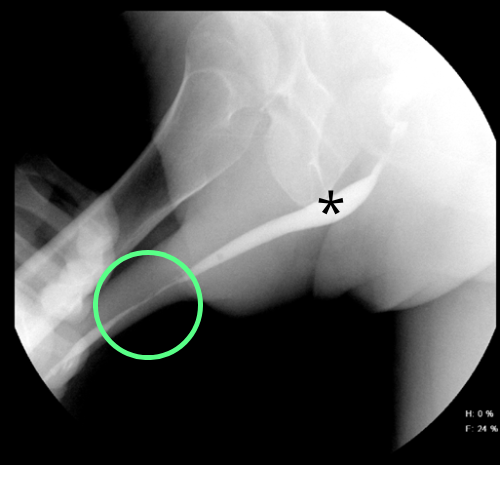 Imagen de cistouretrografía con referencias que permiten identificar un segmento uretral con calibre normal y uno con calibre reducido.