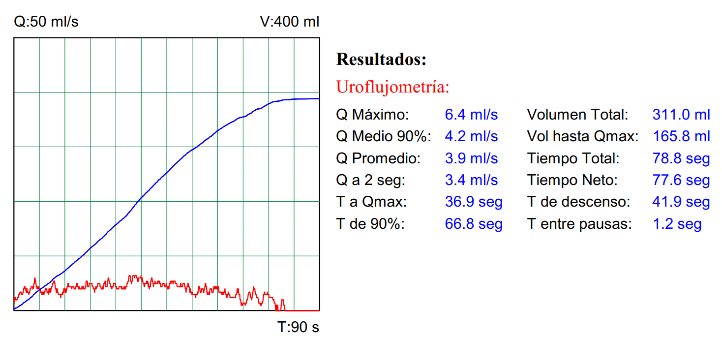 Imagen que muestra un informe de flujometría miccional con parámetros característicos de la estenosis uretral