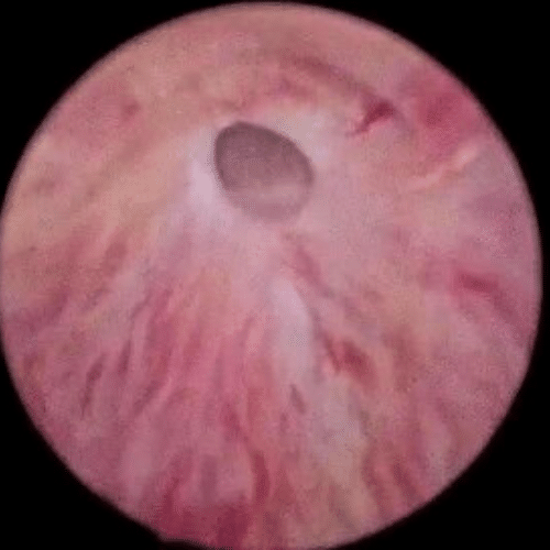 Imagen de uretrocistoscopía que muestra una estenosis uretral