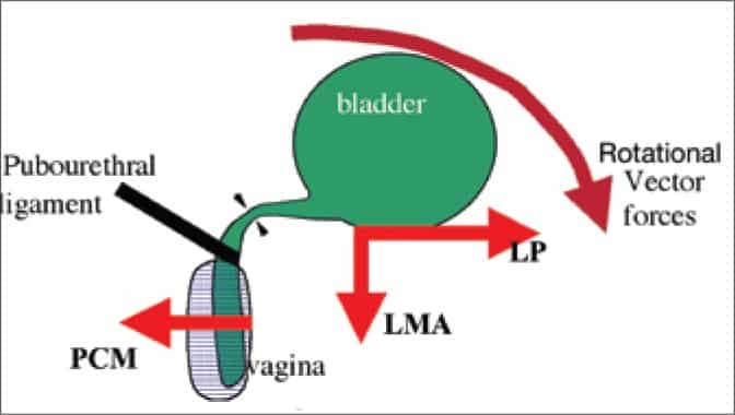 La batalla científica por la incontinencia urinaria femenina: ¿Por qué los expertos no se ponen de acuerdo?