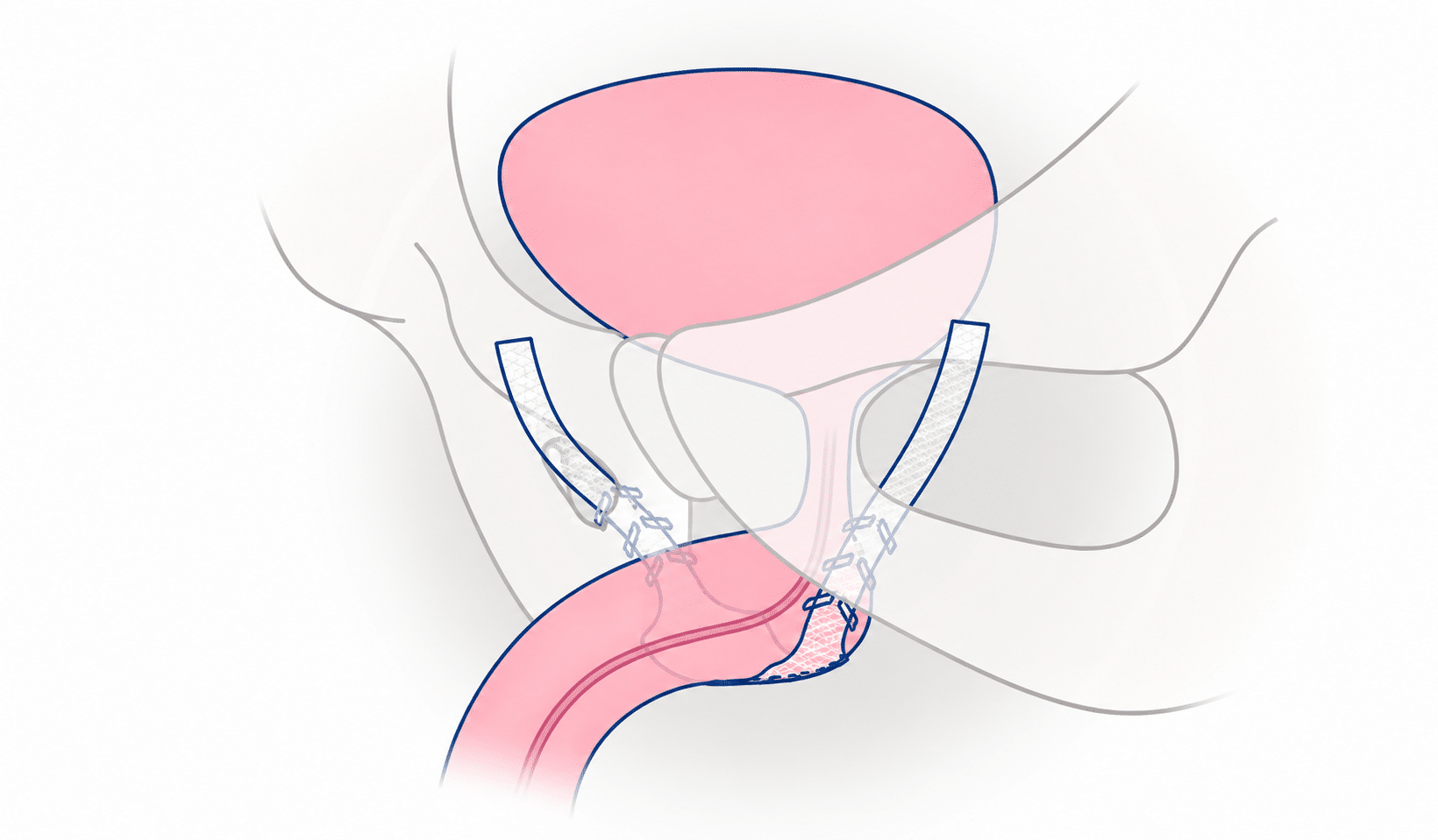 sling fijo para incontinencia urinaria masculina